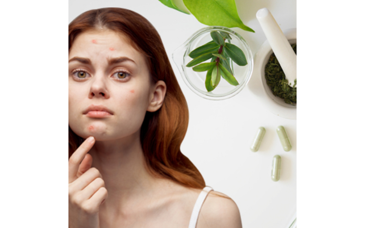 The Ayurvedic Approach to Treating Acne